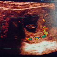 Ayuda con método ramzi: niño o niña? - 1