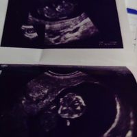 Ayuda con método ramzi: niño o niña? - 1