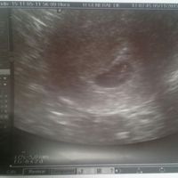Buscadoras después de uno o varios abortos  - 1