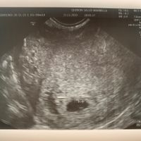 Ayuda con método ramzi: niño o niña? - 1