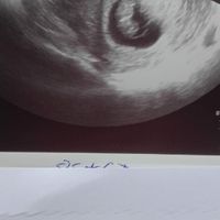 Ayuda con método ramzi: niño o niña? - 1