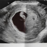 Ayuda con método ramzi: niño o niña? - 1