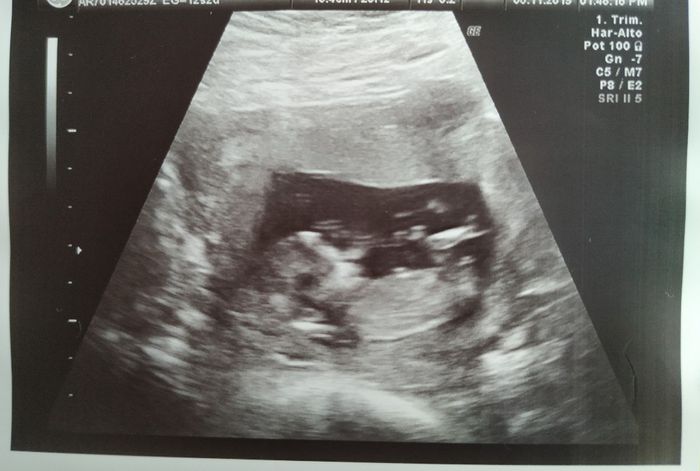 12 semanas abdominal