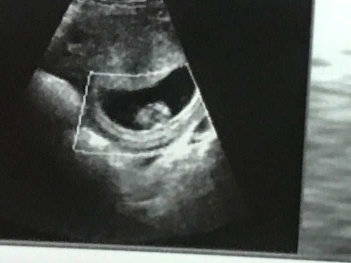 Ayuda con método ramzi: niño o niña? - 2