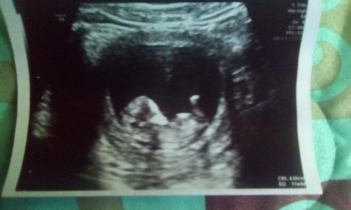 Tubérculo genital: niña 15