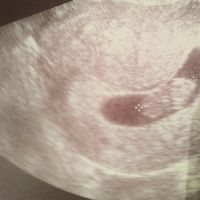 Ayuda con método ramzi: niño o niña? - 1