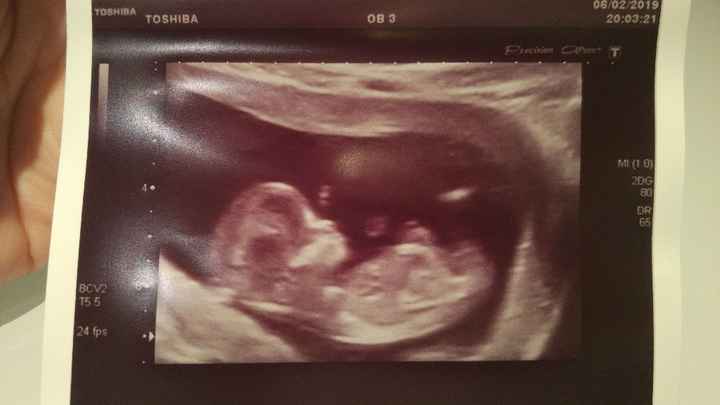 Tubérculo genital niño o niña??? - 1