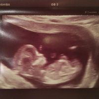 Tubérculo genital niño o niña??? - 1