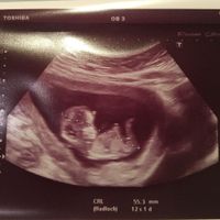 Tubérculo genital niño o niña??? - 2