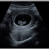 Ayuda con método ramzi: niño o niña? - 1
