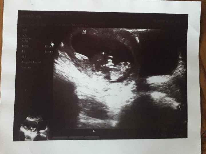 Tubérculo genital: niña - 1