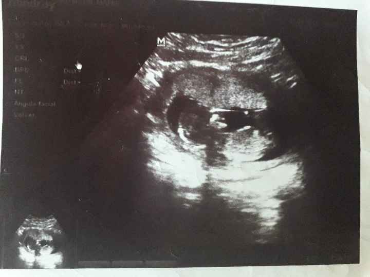 Tubérculo genital: niña - 1