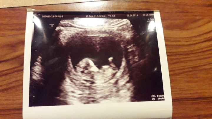 Tubérculo genital: niña - 2