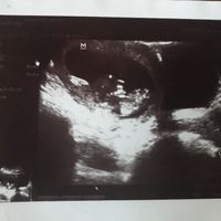 Tubérculo genital: niña - 1