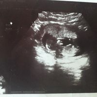 Tubérculo genital: niña - 1
