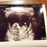 Tubérculo genital: niña - 2