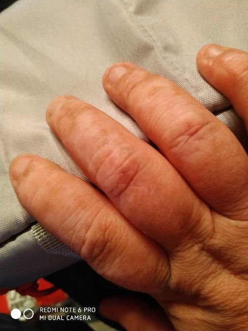 Dermatitis - 1