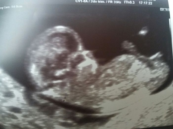 semana 11+5 abdominal aunque creo no se ve la placenta