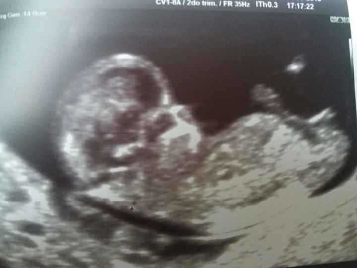 semana 11+5 abdominal aunque creo no se ve la placenta