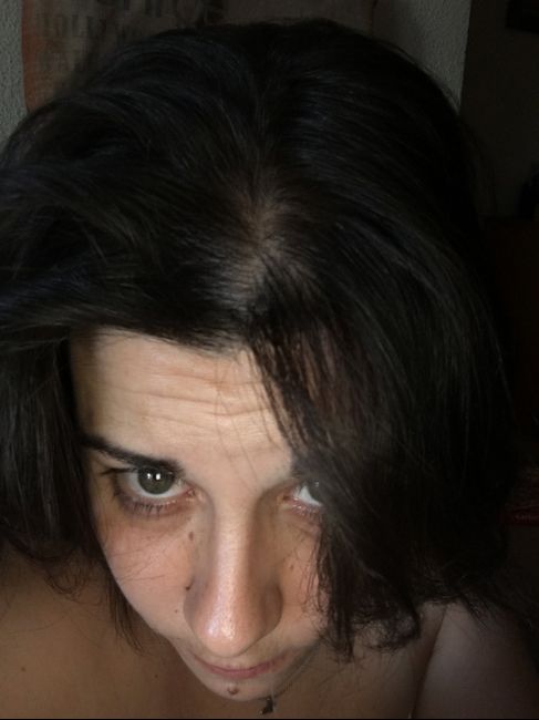 Tengo escasez de pelo y muy fino - 2