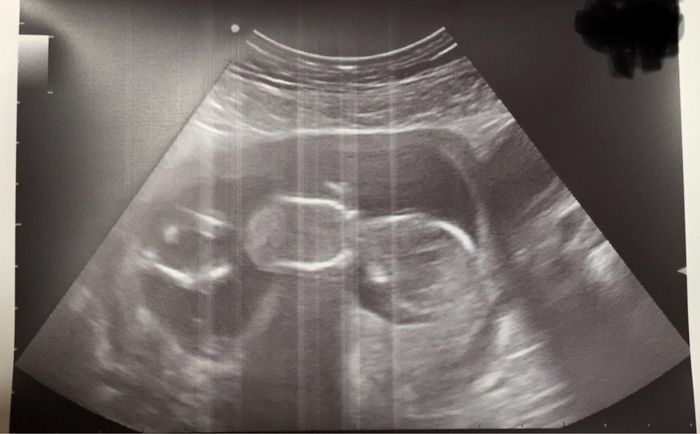 Ayuda con método ramzi: niño o niña? - 1