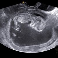 Ayuda con método ramzi: niño o niña? - 1