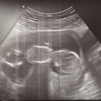 Ayuda con método ramzi: niño o niña? - 1