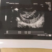 Metodo saad ramzi para saber el sexo del bebe - 1