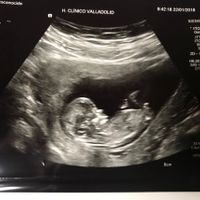  Niño o niña? Eco de 12 semanas - 1