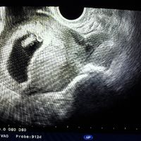 Ayuda con método ramzi: niño o niña? - 1