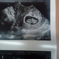 Ayuda con método ramzi: niño o niña? - 3