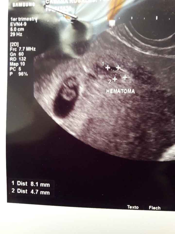 Ayuda con método ramzi: niño o niña? 9