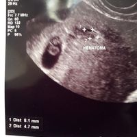 Ayuda con método ramzi: niño o niña? - 1
