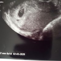 Ayuda con método ramzi: niño o niña? - 2