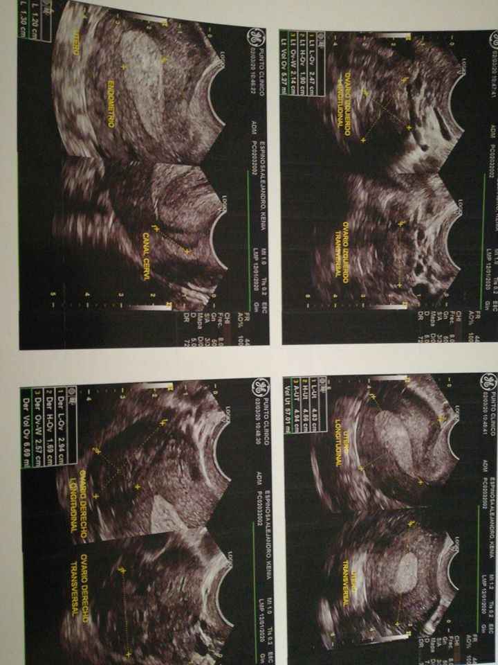 7 semanas por fum y que ya no ven sacao gestacional - 1