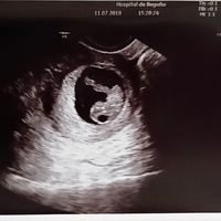 Ayuda con método ramzi: niño o niña? - 1