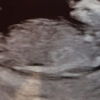 Ayuda con método ramzi: niño o niña? - 1