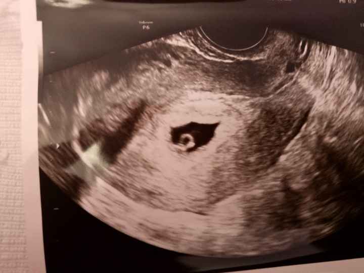 Tubérculo genital: niña 8