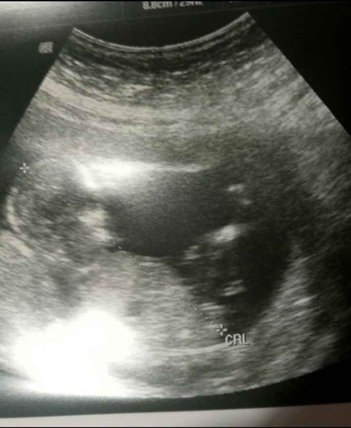 Tubérculo genital: niña 2