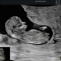 Tubérculo genital: niña - 1