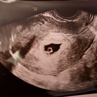 Tubérculo genital: niña - 1