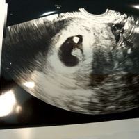 Tubérculo genital: niña - 3