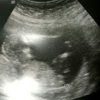 Tubérculo genital: niña - 1