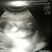 Tubérculo genital: niña - 1