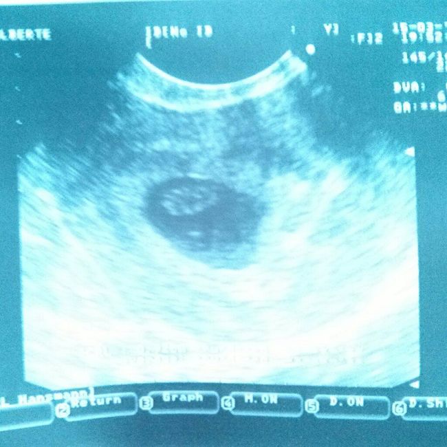 Ayuda con método ramzi: niño o niña? - 1