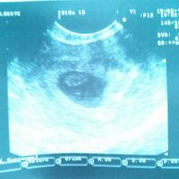 Ayuda con método ramzi: niño o niña? - 1