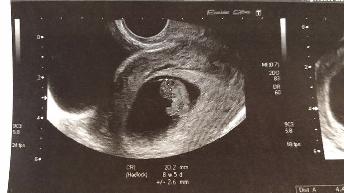 Ayuda con método ramzi: niño o niña? - 1