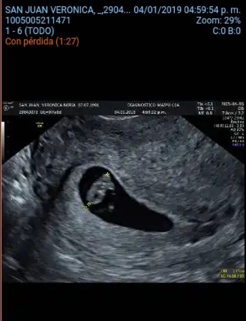Ayuda con método ramzi: niño o niña? 4