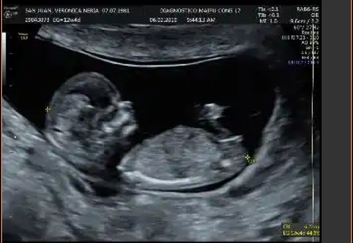 Ayuda con método ramzi: niño o niña? - 1
