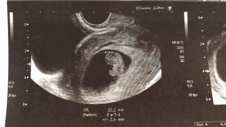 Ayuda con método ramzi: niño o niña? - 1